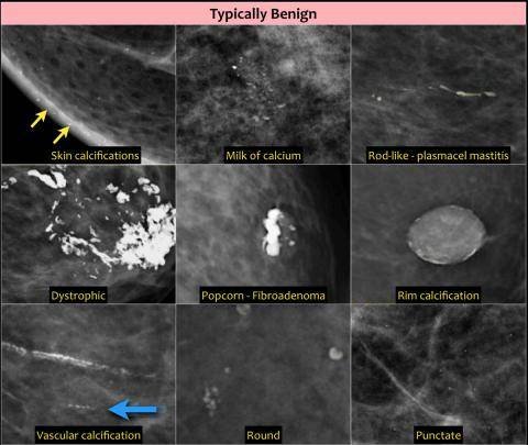 What To Know About Calcium Deposits In The Breast