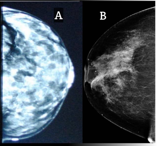 Comparison of the mammogram of an extremely dense breast and that of breast cancer.