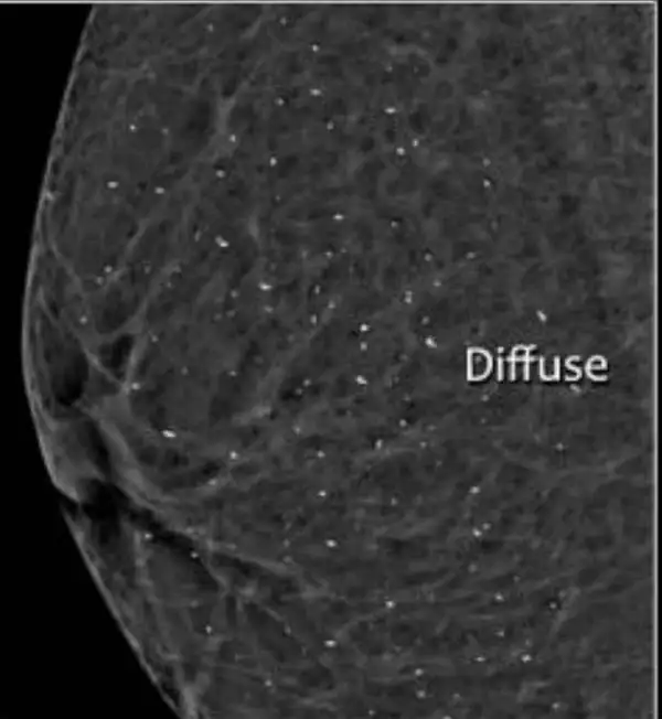 Breast calcification in a mammogram.