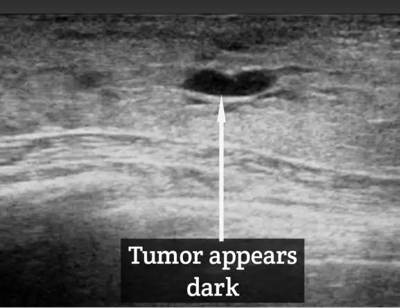 Mammogram for implants. 6 A breast Ultrasound showing a tumor.