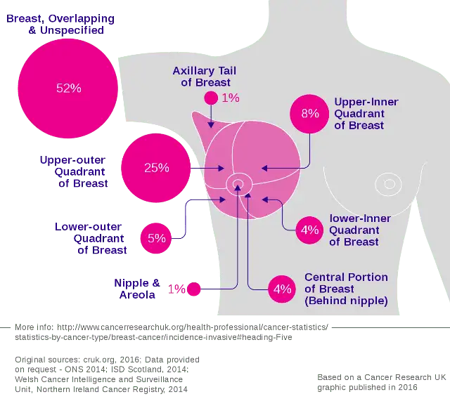 Breast cancer incidence by anatomical site.