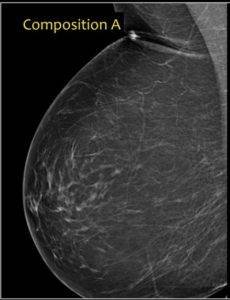 Category A. Mammogram of mostly fatty breast tissues.
