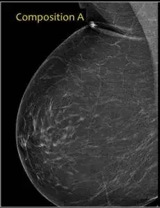 Category A. Mammogram of mostly fatty breast tissues.