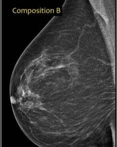 Mammogram of breast with mostly fatty tissues in addition to scattered areas of fibroglandular dense tissues. 