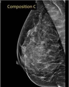 Mammogram of dense breast1.Heterogeneously dense breast.
