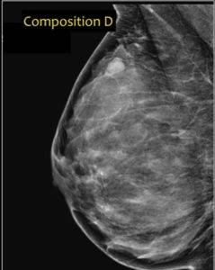 Mammogram for dense breast 2. Extremely dense breast.