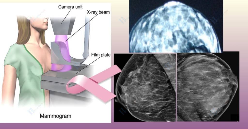 Mammogram for dense breasts.