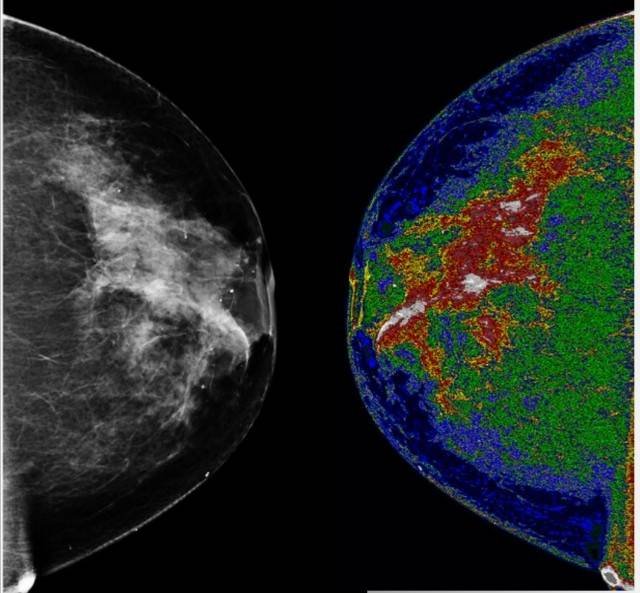 Mammogram of breast cancer.
