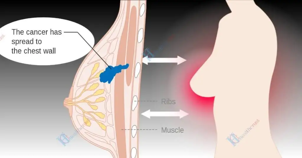 Spreading cancerous tumor.