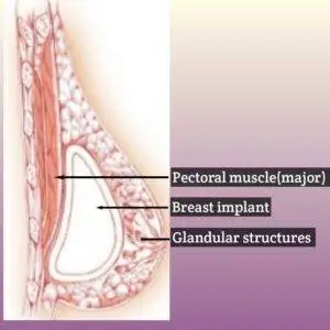 Mammogram for implants. 3 Subglandular Implant placement