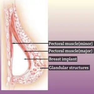 Mammogram for implants. 4 Subpectoral Implant placement.