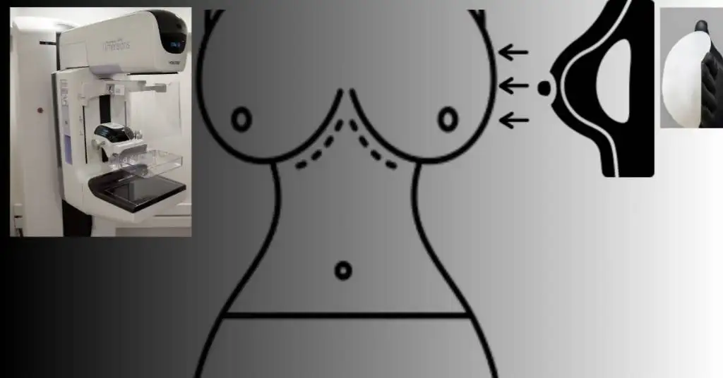 Mammogram for implants. 1 Mammogram for implants