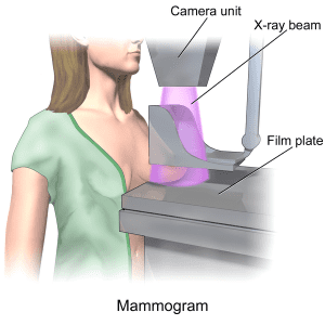 Mammography demonstrated