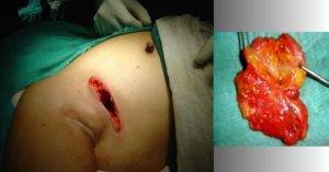 Breast biopsy with excision