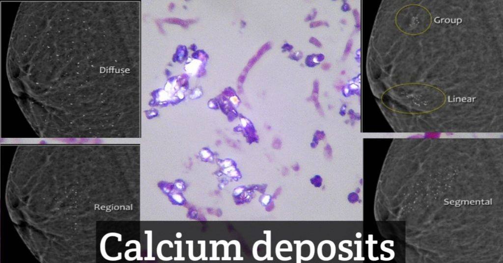Calcium deposits.