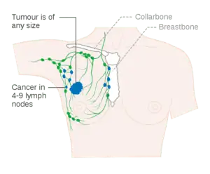 Metastasis of breast cancer to surrounding lymph nodes