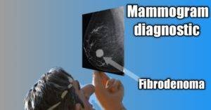 Mammogram Diagnostic