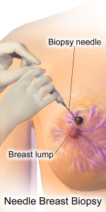 Needle breast Biopsy