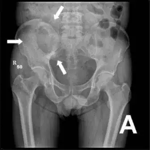 Breast Cancer metastasis to the bones