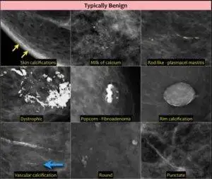 Various kinds of benign calcium deposits