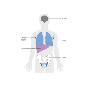 Main sites in the body where breast cancer spreads