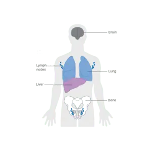 Main sites in the body where breast cancer spreads