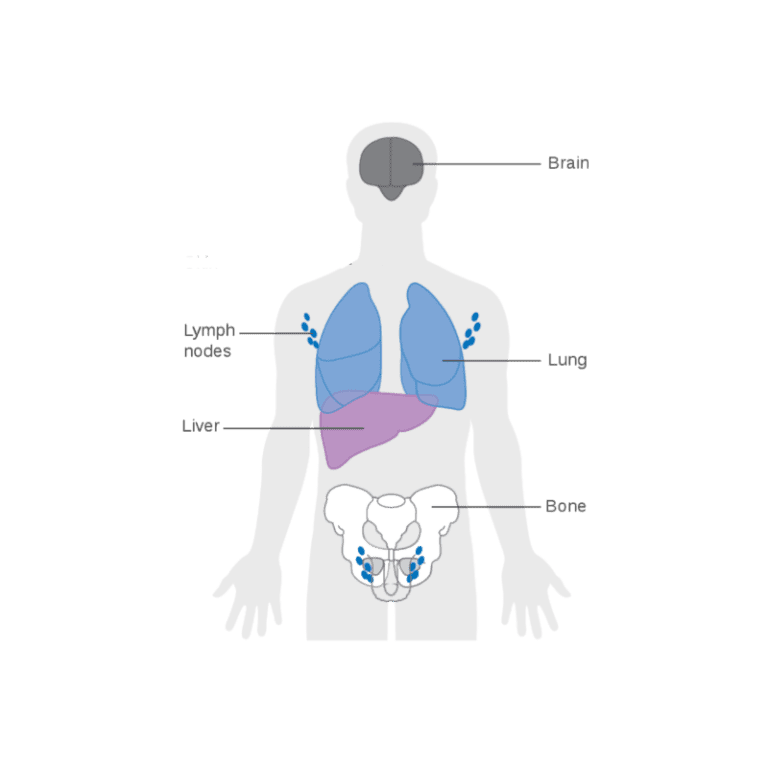 Detailed metastasis of breast cancer symptoms worth knowing