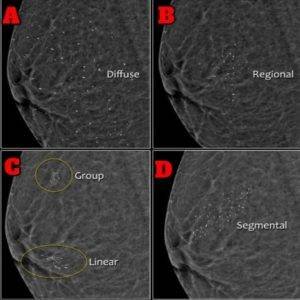 Distribution of calcium deposits in the breast.
