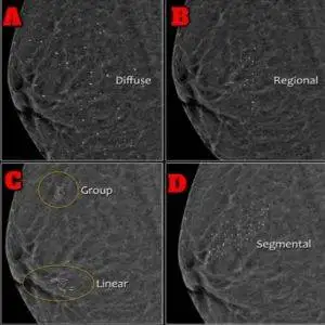 Distribution of calcium deposits in the breast.