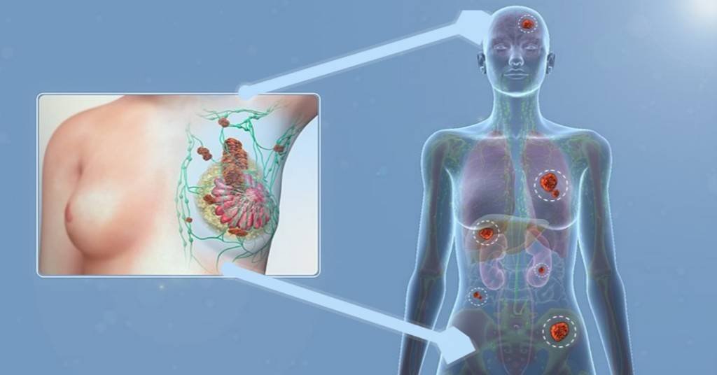 Metastasis breast cancer