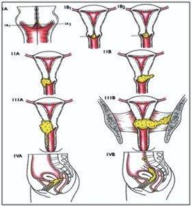 The stages of cervical cancer.