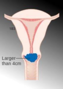 Diagram showing Cervical Cancer stage 1B3