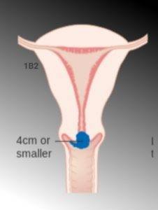 Diagram showing cervical cancer stage 1B2