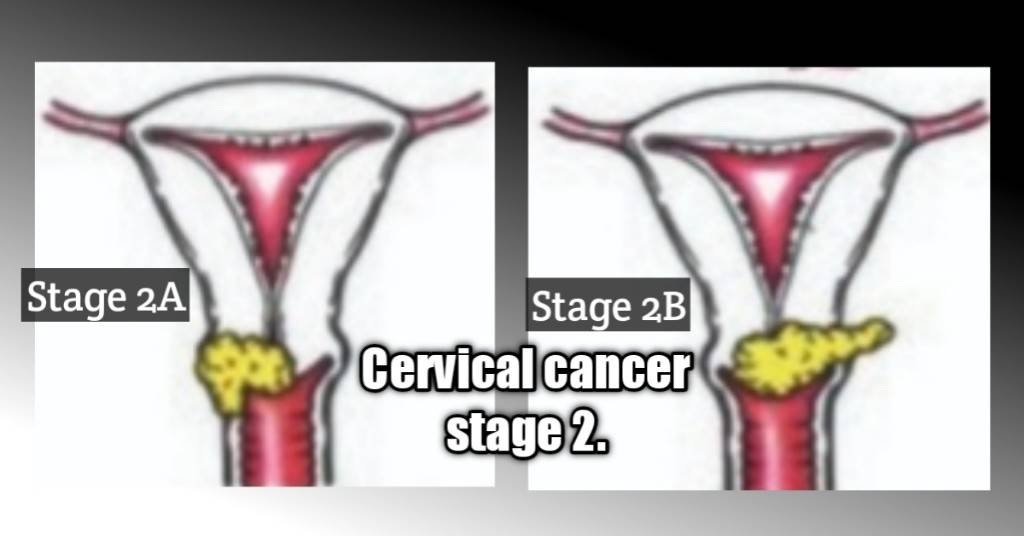 cervical cancer stages 2