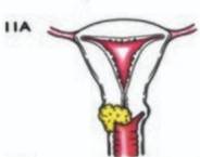 Stage 2A cervical cancer