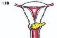 Cervical cancer stage 2B