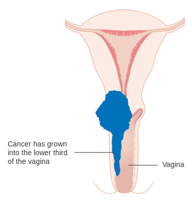 Cervical cancer stage 3A