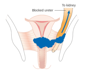 cervical cancer stage 3B