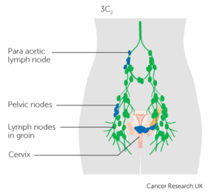 cervical cancer stage 3C2