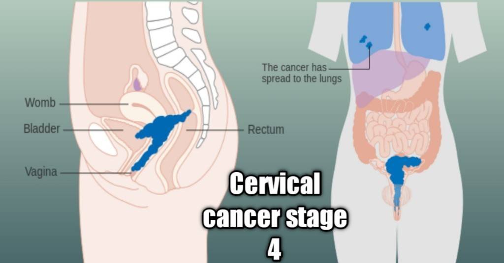 cervical cancer stages 4