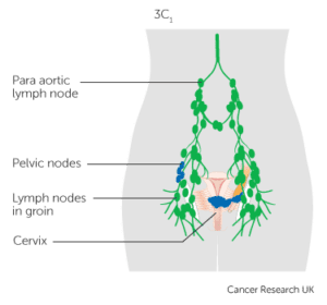 Cervical cancer stage 3C1 