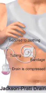 Reconstruction of breast after cancer. 4 Jackson Pratt post breast surgery drain.