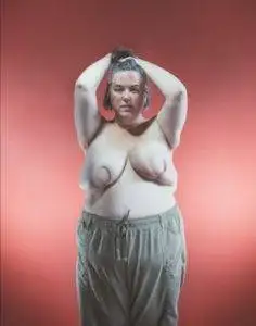 Reconstruction of breast after cancer. 2 reconstructed breast before nipple reconstruction.