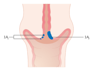 Stage 1A cervical cancer