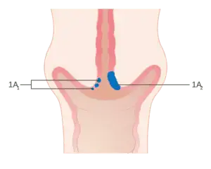 Stage 1A cervical cancer
