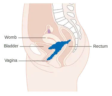 Cervical cancer stage 4. 2 Stage 4A cervical cancer