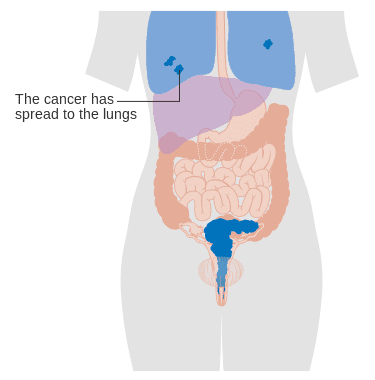 stage 4b cervical cancer