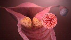The HPV that causes cervical cancer
