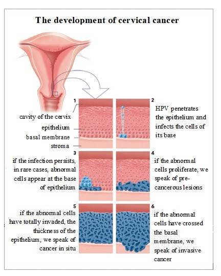 The development of cervical cancer