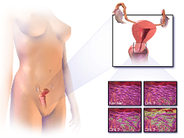levels of cervical dysplasia